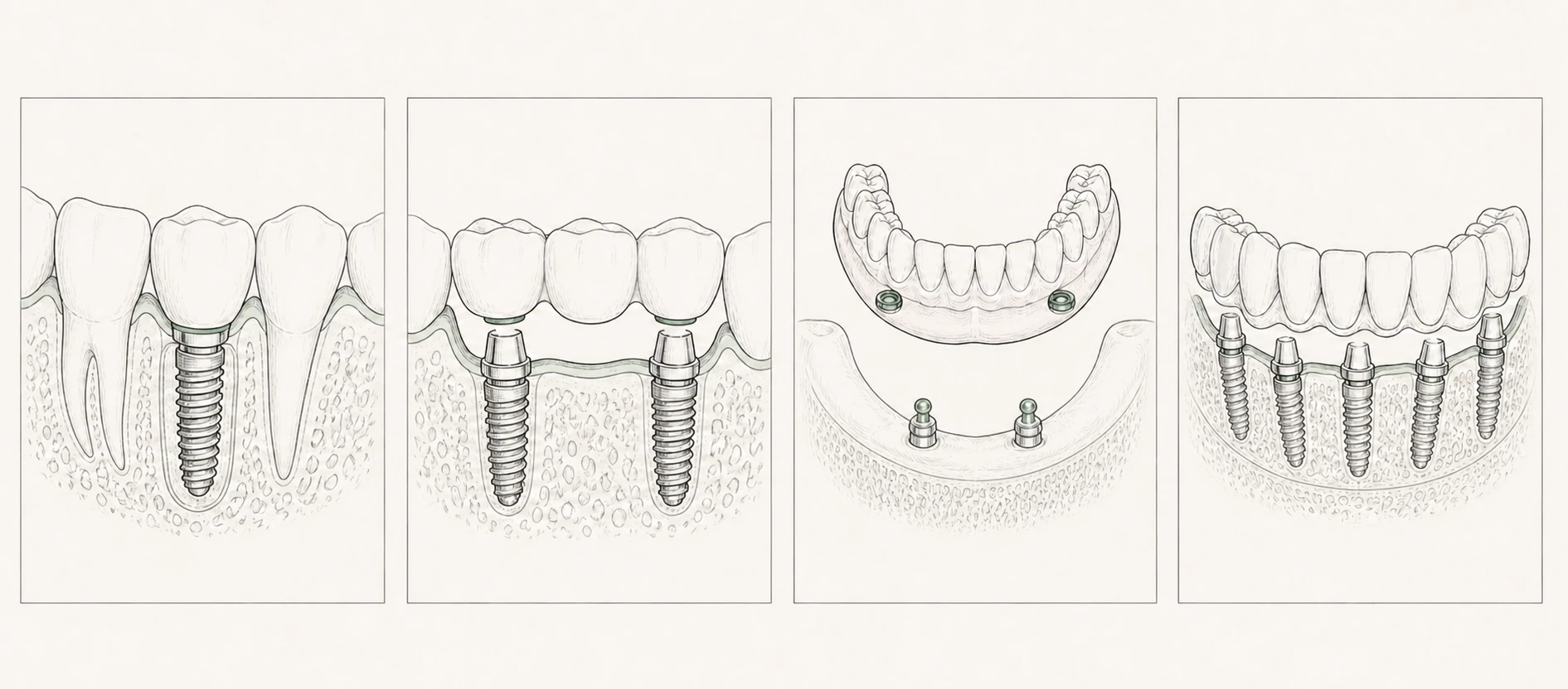 Minimalistische lijnillustratie van een klikgebit op implantaten