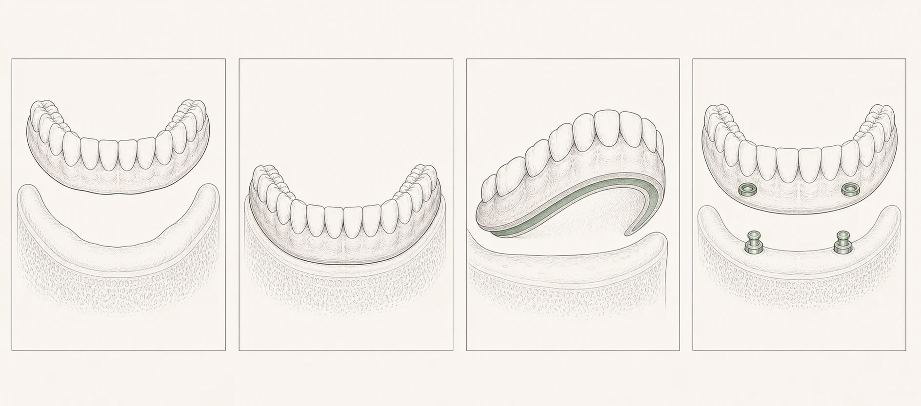 Lijnillustraties van onderzoek, implantaten, genezing en een klikgebit.